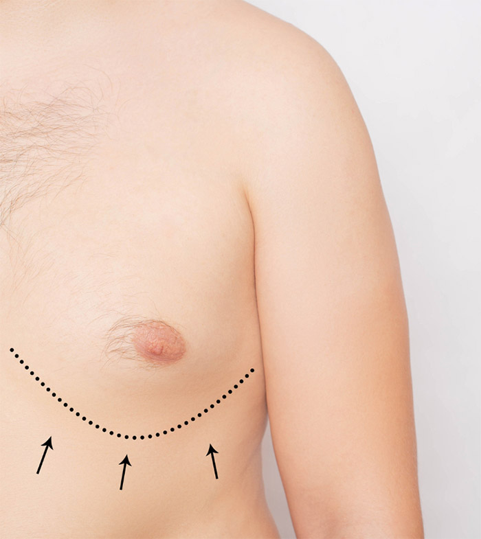 Male breast reduction model poses with graphics showing how male breast reduction works at Viradia Plastic Surgery in Tampa, FL