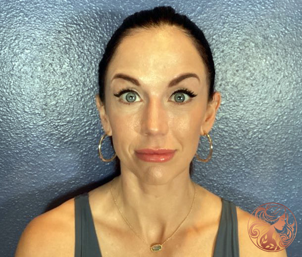 Botox after photo, patient #2, Viradia Plastic Surgery.