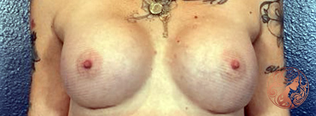 Breast augmentation and breast implant exchange after photo #1, Viradia Plastic Surgery.