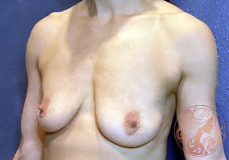 Breast lift before photo #2, Viradia Plastic Surgery.