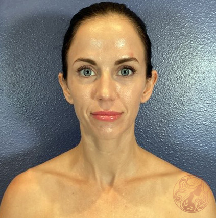 CO2 laser resurfacing after photo #1, Viradia Plastic Surgery.