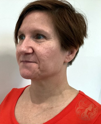 CO2 laser resurfacing before photo #2 - three-quarter view, Viradia Plastic Surgery.