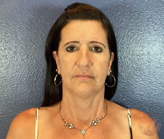 Face lift after photo #1, Viradia Plastic Surgery.