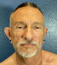 Facial fat grafting before photo #2 - three-quarter view, Viradia Plastic Surgery.