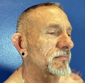 Facial fat grafting after photo #2 - three-quarter view, Viradia Plastic Surgery.