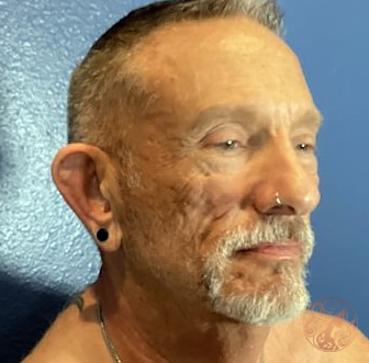 Facial fat grafting before photo #1 - three-quarter view, Viradia Plastic Surgery.