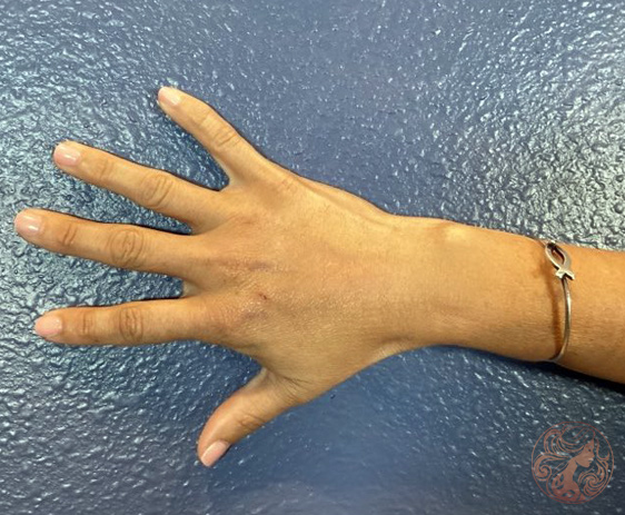 Hand fat grafting after photo #1, Viradia Plastic Surgery.