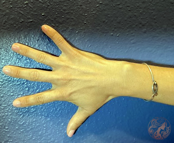 Hand fat grafting before photo #1, Viradia Plastic Surgery.