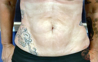 Liposuction after photo #1, Viradia Plastic Surgery.