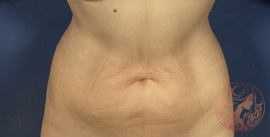 Liposuction after photo #2, Viradia Plastic Surgery.