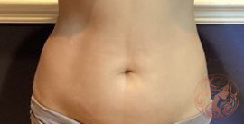 Liposuction before photo #2, Viradia Plastic Surgery.