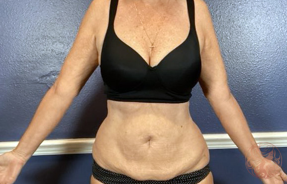 Liposuction before photo #3, Viradia Plastic Surgery.