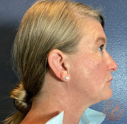 Mole removal after photo #1, Viradia Plastic Surgery.