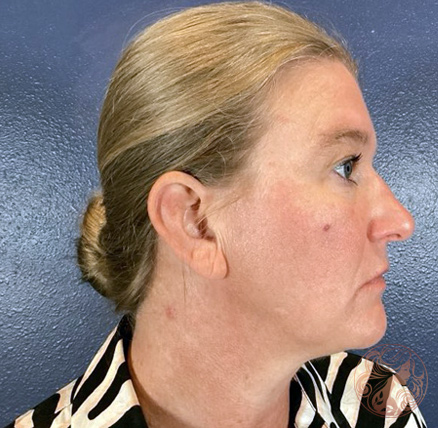 Mole removal before photo #1, Viradia Plastic Surgery.