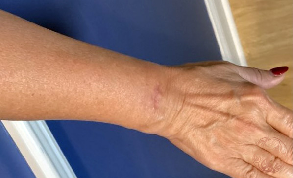 Scar revision after photo #1, Viradia Plastic Surgery.