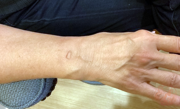 Scar revision before photo #1, Viradia Plastic Surgery.