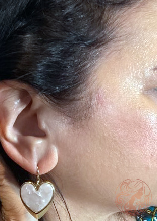 Scar revision after photo #2 - side profile, Viradia Plastic Surgery.
