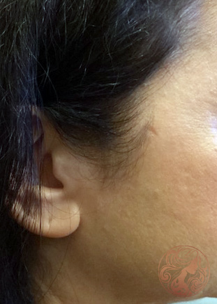 Scar revision before photo #2 - side profile, Viradia Plastic Surgery.