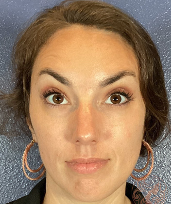 Botox after photo, patient #3, Viradia Plastic Surgery.