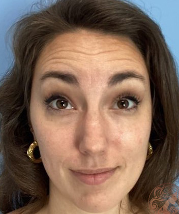Botox before photo, patient #3 Viradia Plastic Surgery.