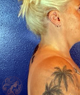 Buffalo hump removal after photo #1 - side profile, Viradia Plastic Surgery.