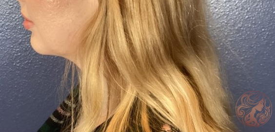 Chin implant after photo #1 - side profile, Viradia Plastic Surgery.