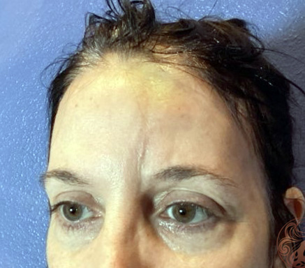 Facial fat grafting to facial dent after photo #1, Viradia Plastic Surgery.