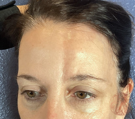 Facial fat grafting to facial dent before photo #1, Viradia Plastic Surgery.