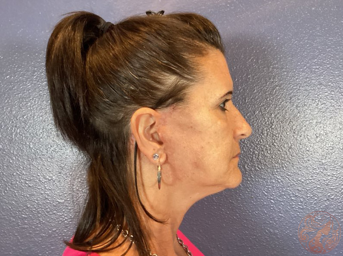 Neck lift after photo #1 - side profile, Viradia Plastic Surgery.