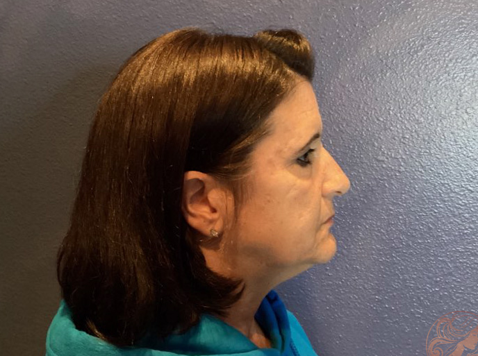 Neck lift before photo #1 - side profile, Viradia Plastic Surgery.