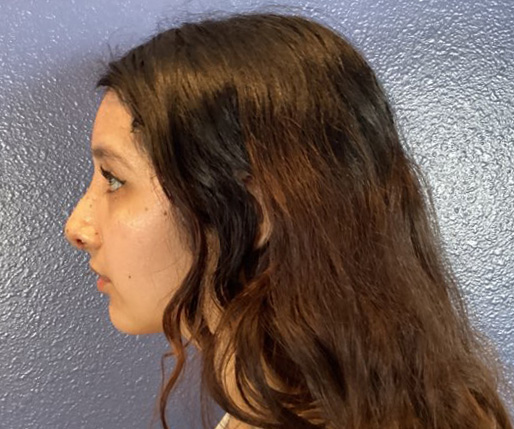 Rhinoplasty after photo #1 - side profile, Viradia Plastic Surgery.