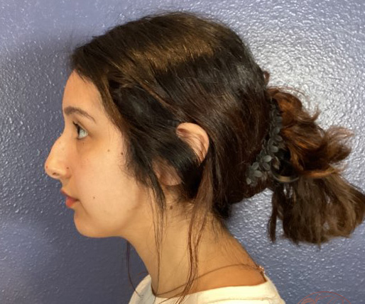 Rhinoplasty before photo #1 - side profile, Viradia Plastic Surgery.