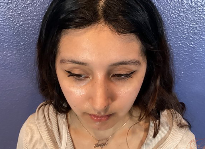 Rhinoplasty after photo #2 - front profile, Viradia Plastic Surgery.