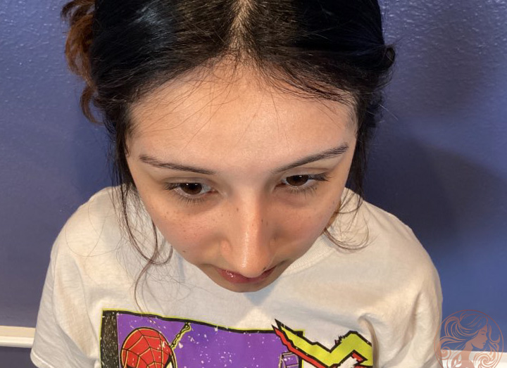 Rhinoplasty before photo #2 - front profile, Viradia Plastic Surgery.