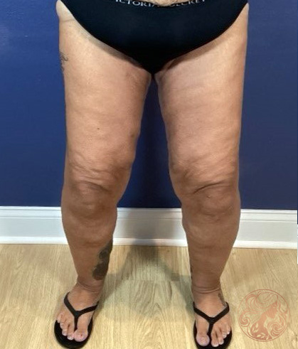 Thigh lift surgery after photo #1, Viradia Plastic Surgery.