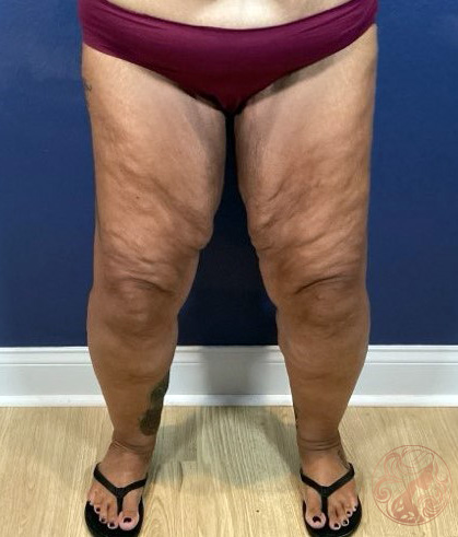 Thigh lift surgery before photo #1, Viradia Plastic Surgery.