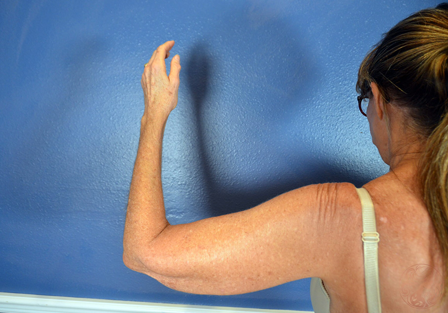 Arm lift (brachioplasty) patient, before, front view, Viradia Plastic Surgery.