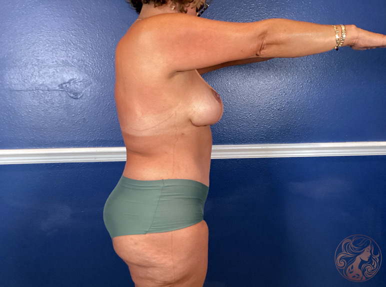 Bilateral breast lift and a traditional abdominoplasty with rectus plication, after surgery. Side view 1, Viradia Plastic Surgery.