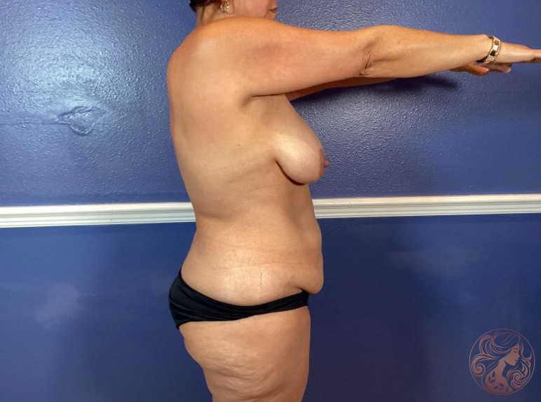 Bilateral breast lift and a traditional abdominoplasty with rectus plication, before surgery. Side view 1, Viradia Plastic Surgery.