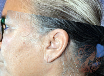 Earlobe reconstruction patient, after, side view, Viradia Plastic Surgery.