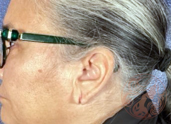 Earlobe reconstruction patient, before, side view, Viradia Plastic Surgery.