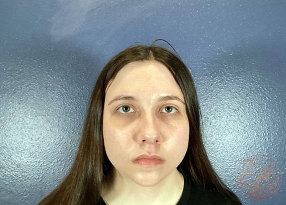 Upper blepharoplasty patient, after, front view, Viradia Plastic Surgery.