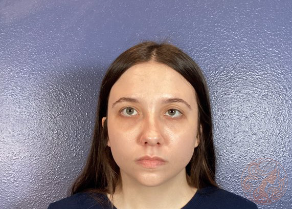 Upper blepharoplasty patient, before, front view, Viradia Plastic Surgery.