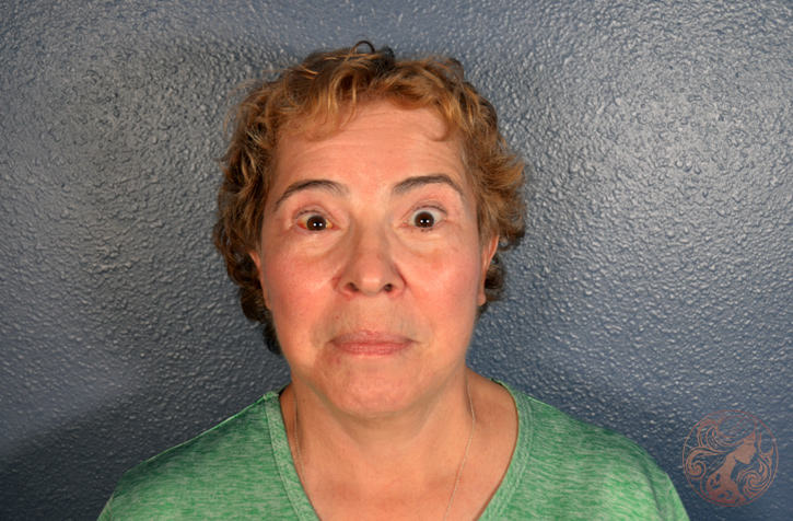 Deep plane facelift with neck lift, blepharoplasty, brow lift, fat grafting, and CO2 laser resurfacing, after treatment, front view showing a refined jawline, more open eyes, lifted brows, and smoother skin. Viradia Plastic Surgery.