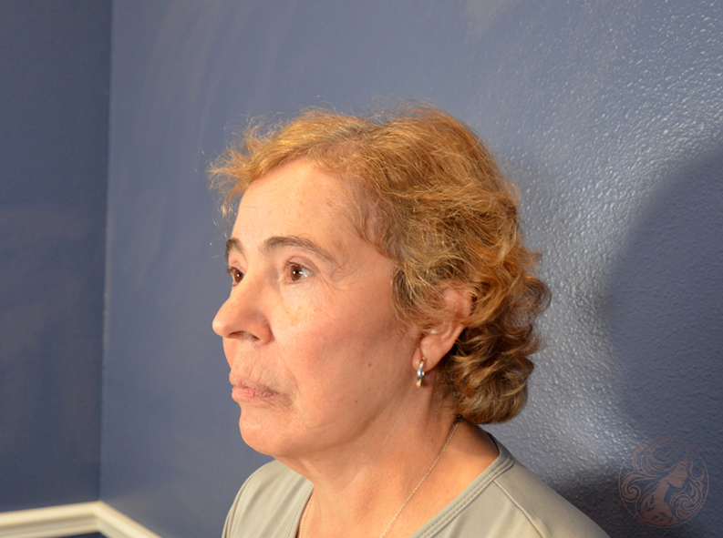 Deep plane facelift combination, after treatment, angled view showing improved contours, lifted brows, and smoother skin. Viradia Plastic Surgery.