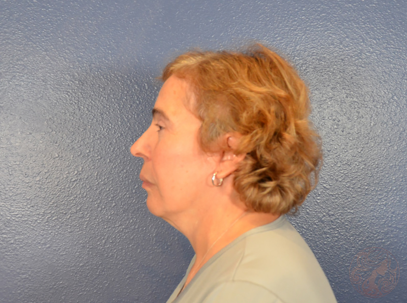 After treatment side view showing improved jawline definition, smoother neck, and rejuvenated eyes. Viradia Plastic Surgery.