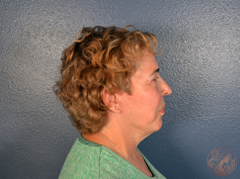 After angled view showing improved contours and smoother skin.