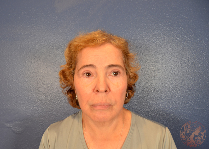 After profile view showing improved structure and smoother contour.