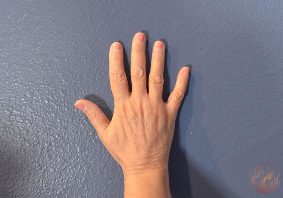 After showing restored facial contours and more youthful hands.