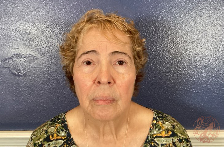 Deep plane facelift with neck lift, blepharoplasty, brow lift, fat grafting, and CO2 laser resurfacing, before treatment, front view showing facial sagging, eyelid heaviness, and skin texture changes. Viradia Plastic Surgery.